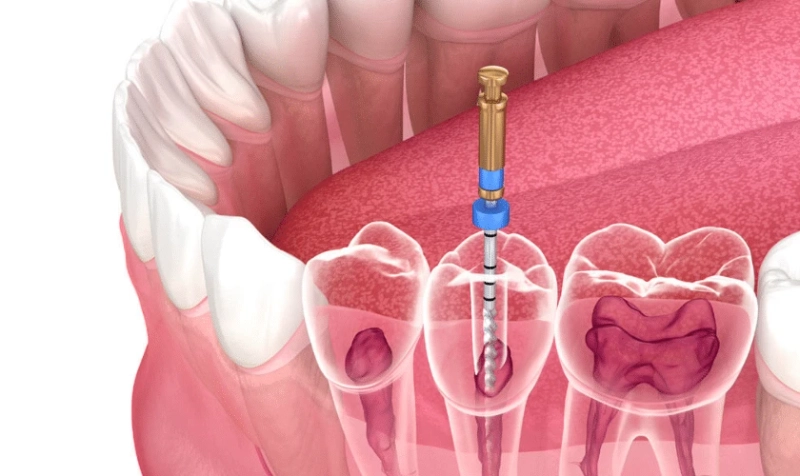 Best Dentist for Root Canal Treatment in Noida – What to Look For