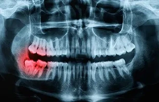 Gum Surgery Explained: Healing, Benefits, and Recovery Tips
