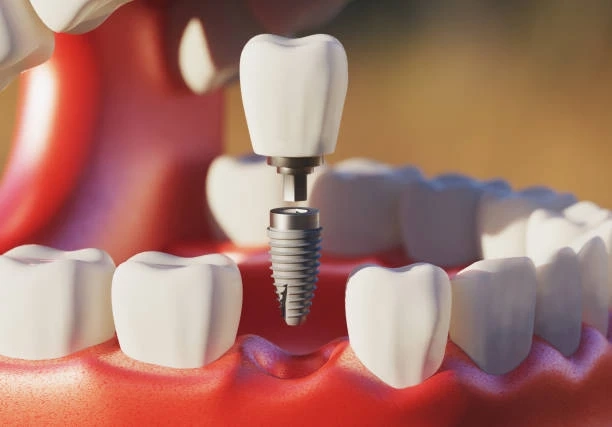 Advanced Care for Tooth Infections Root Canal Treatment in Islamabad: