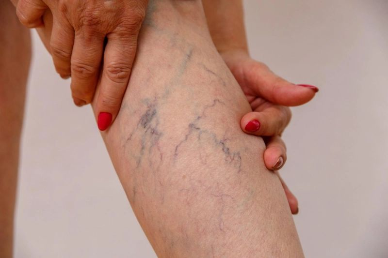 Which Specialist Should You Consult for Varicose Veins?