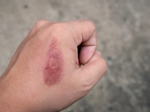 What you need to know about burns? | An Overview
