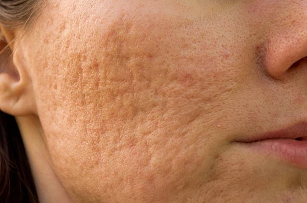 Understanding Different Types of Acne Scars: A Comprehensive Guide