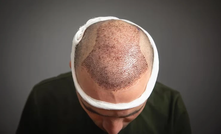 Hair Loss Ends Here: The Best UK Hair Transplant Clinic in Manchester Revealed