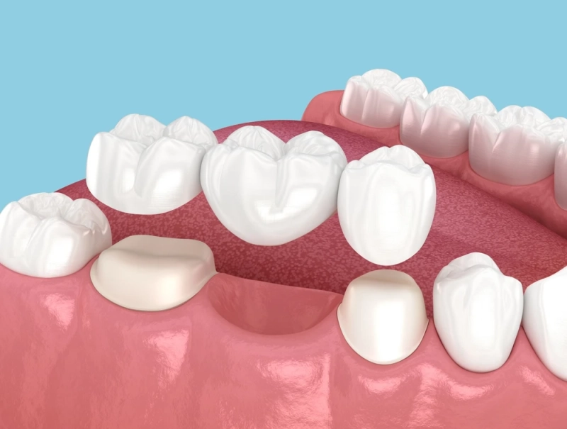 Restore Your Smile and Confidence with Dental Bridges in Calgary
