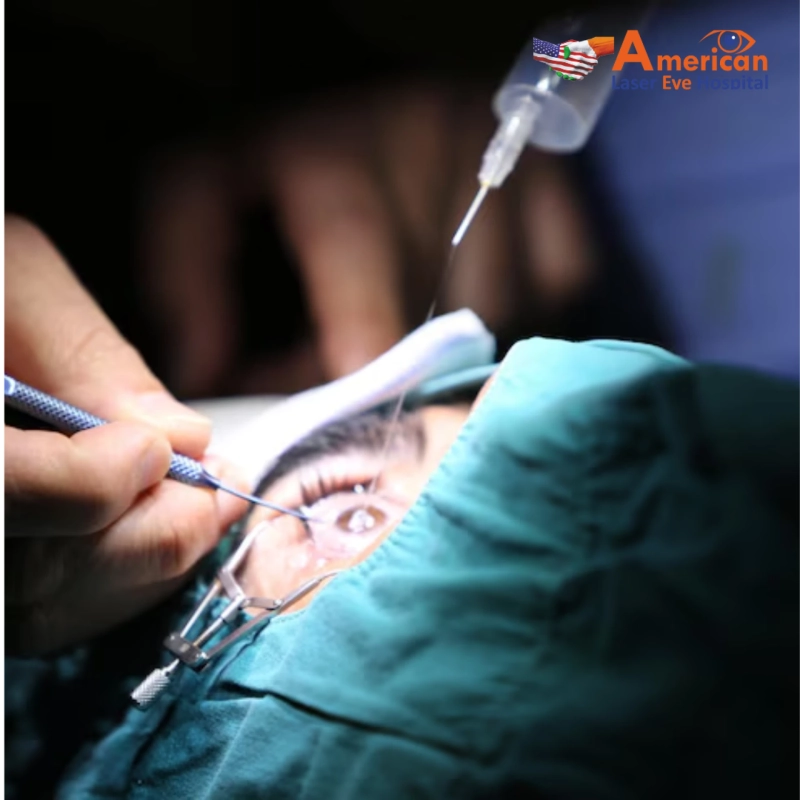 Best Lasik Eye Surgery In Hyderabad |  American Laser Eye Hospitals