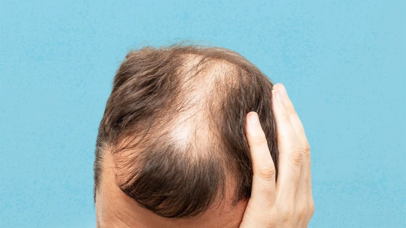 Fighting Hair Loss with Nutrition: Superfoods for Stronger Strands