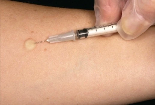 Tuberculosis Vaccine invention provides another example of mankind's ability to find inventive s
