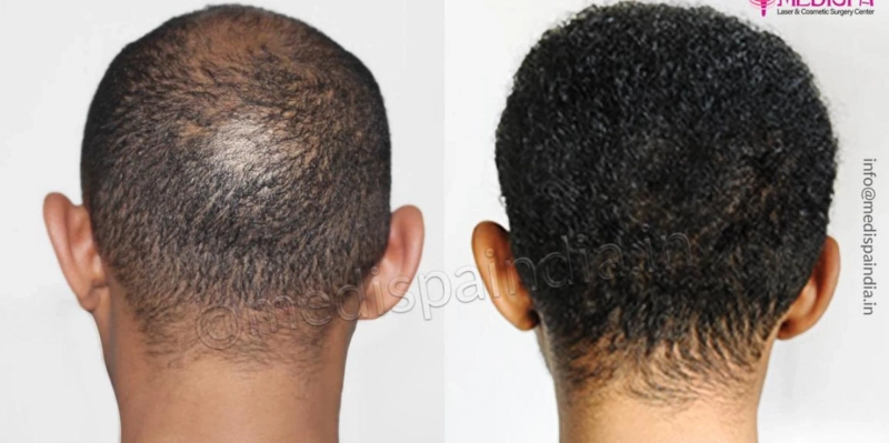 Dangers of Getting Hair Transplant From Inexperienced Surgeon