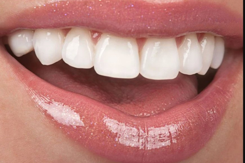 What Are The Benefits Of Porcelain Veneers In Dentistry?