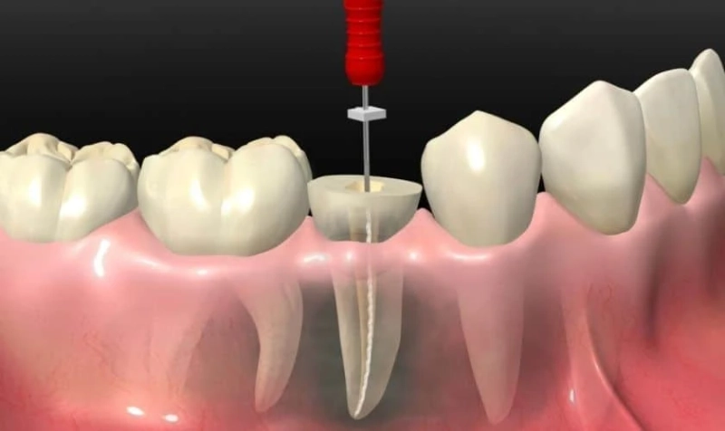 Can Root Canal Treatment Save a Severely Damaged Tooth?
