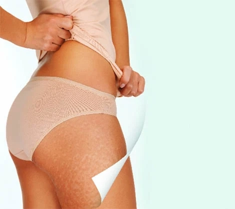 Top Cellulite Treatment Options That Actually Work: A Complete Guide!