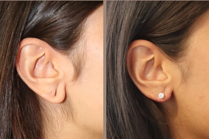 Rejuvenate Your Look with Earlobe Surgery: Everything You Need to Know