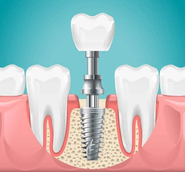 How To Get Dental Implants: A Step-By-Step Guide That Will Help You From Start To Finish