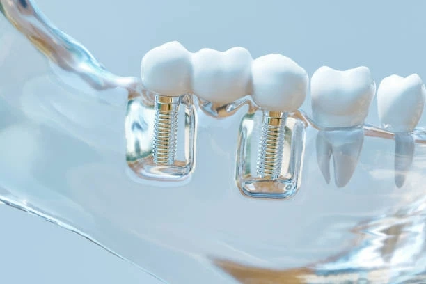 What Are Dental Implants Therapy ?