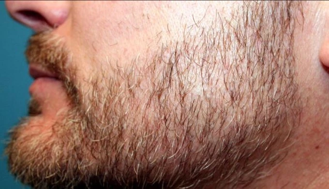 Can beard hair transplant in Dubai help men with alopecia-related facial hair loss?