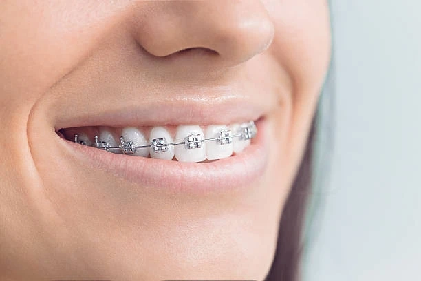 Mistakes To Avoid While Choosing An Orthodontist