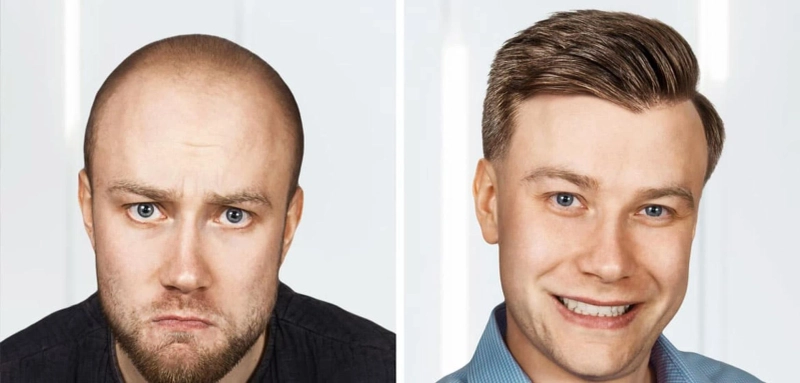 Hair Transplant Success Rates: What to Expect?