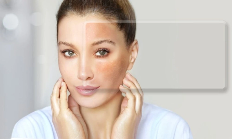 How Do Dermatologists Diagnose Type of Pigmentation?