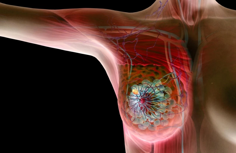 Advancements in Breast Cancer Treatment: A Beacon of Hope in the Fight Against the Disease