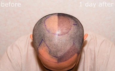 At What Age Is It Most Appropriate To Have A Hair Transplant?