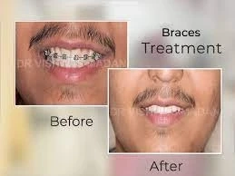 which is the best dental clinic for braces in Hyderabad