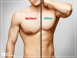 Gynecomastia in Dubai: Causes, Treatment Options, and Benefits