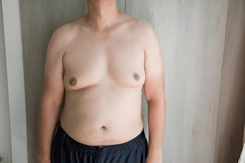 Indications One Needs Gynecomastia Surgery