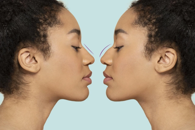 Can I Get a Nose Job If My Nose is Broken?