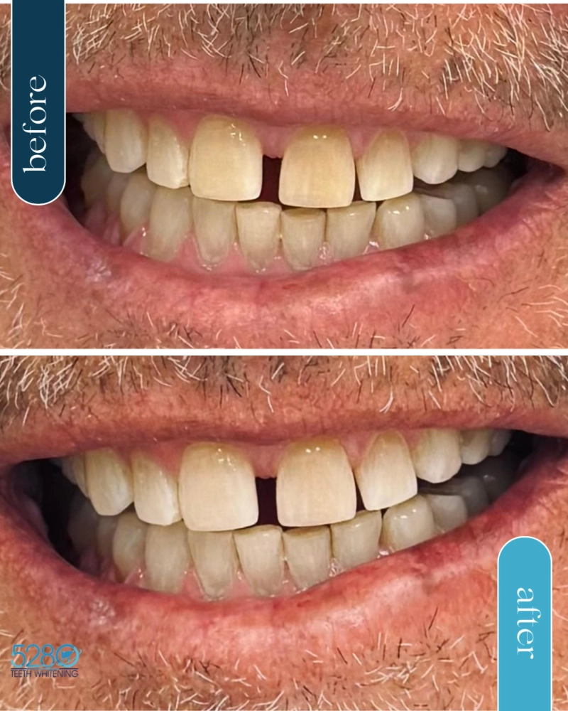 Mobile Teeth Whitening in Denver, Colorado: Brighten Your Smile Anytime, Anywhere