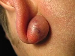 Sebaceous Cyst Treatment Options: What to Expect