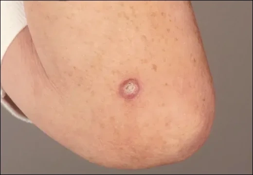 Ayurvedic aspect of Keratoacanthoma