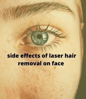 side effects of laser hair removal on face