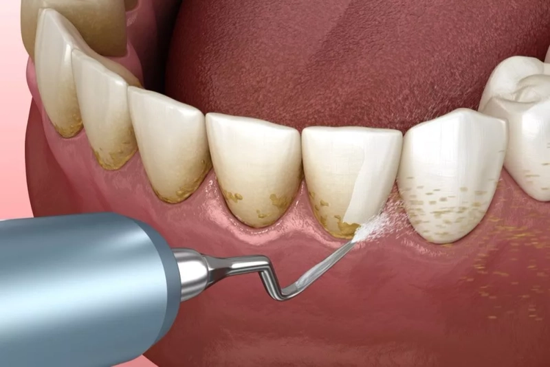 Understanding Modern Tooth Replacement Options in Lawrenceville