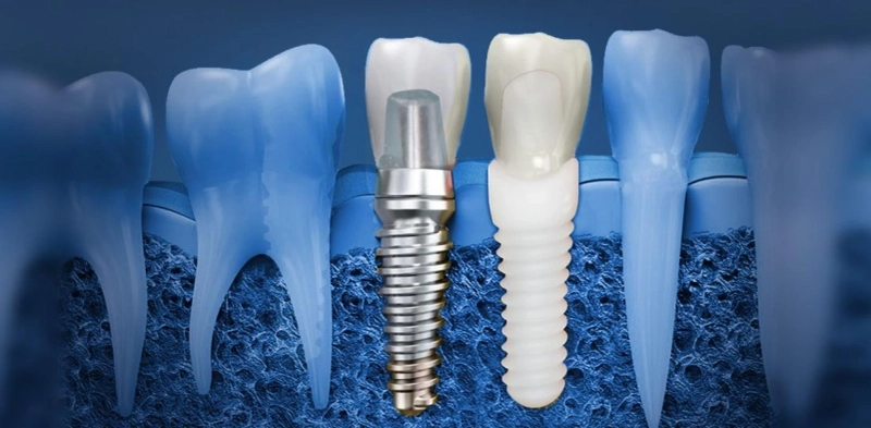 What Are the Advantages of Dental Implants Over Traditional Dentures?