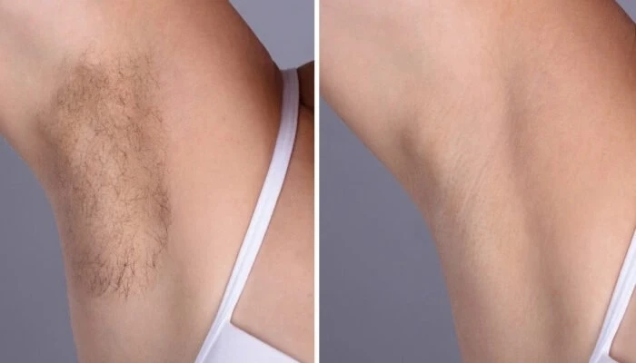 Best Plastic Surgeons in dubai for Luxury Laser Hair Removal Treatments