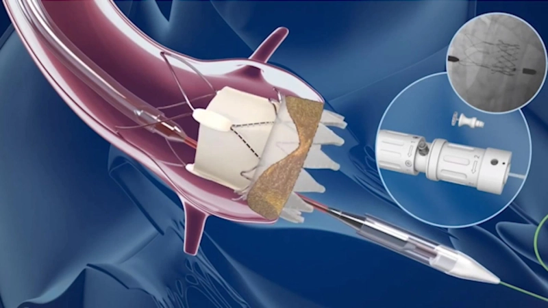 UAE Interventional Cardiology Devices Market to be dominated by Increasing Prevalence of Coronary Artery Diseases through 2027