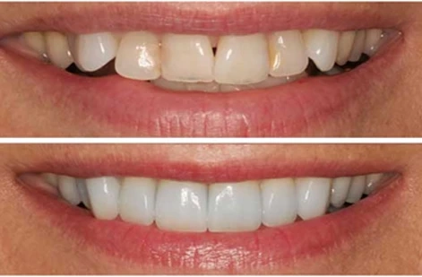 Cosmetic Teeth Contouring: Enhancing Your Smile with Precision and Elegance