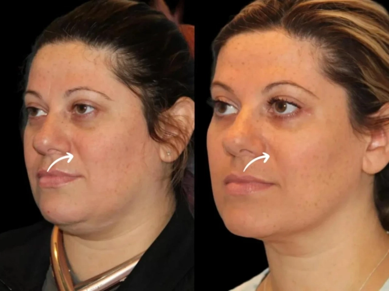 Best Plastic Surgeons in Dubai Using Sculptra for Asian Features
