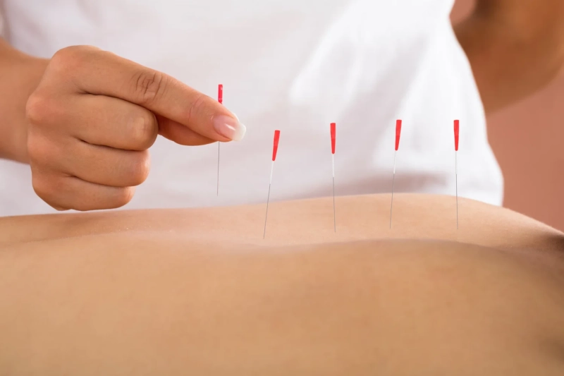 5 Surprising Benefits of Dry Needling You Need to Know About