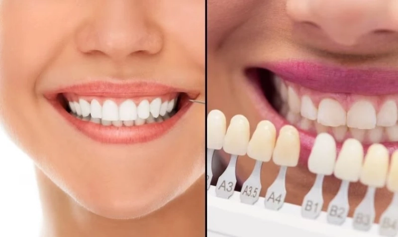 Teeth Whitening vs. Veneers: Which Is Right for You?