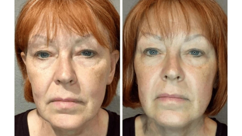 Why Are Radio Frequency Skin Treatments So Popular for Face and Body?