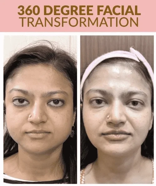 Botox Treatment in Delhi – Cost, Best Clinics, Benefits & More