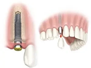Why Dental Implants Are the Best Choice for Tooth Loss