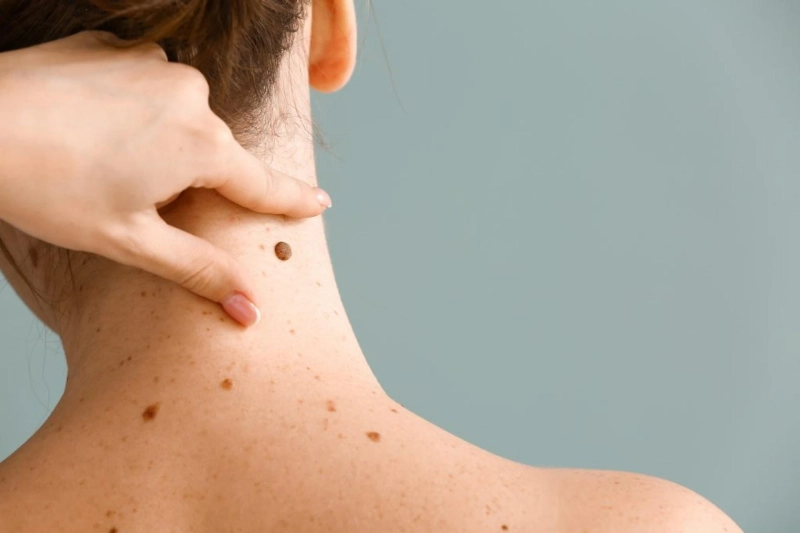 In Actinic Keratoses, A White, Scaly Plaque Of Variable Thickness Surrounds A Reddish Rim