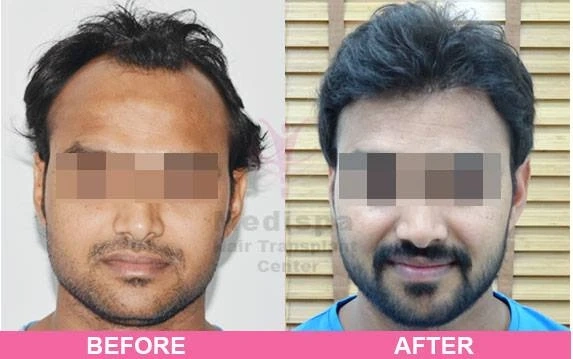 What Complications May Arise After A Hair Transplant Surgery?