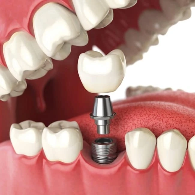 Tulip Dental Care: Leading the Future of Dental Implants in Woodlands, TX