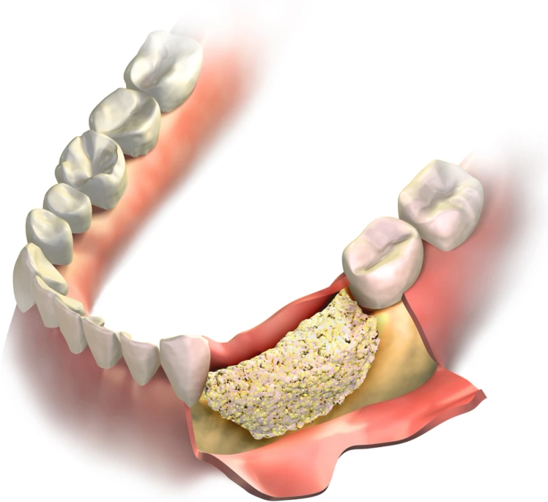 All You Need To Know about Characteristics of a Dental Bone Graft And Substitutes