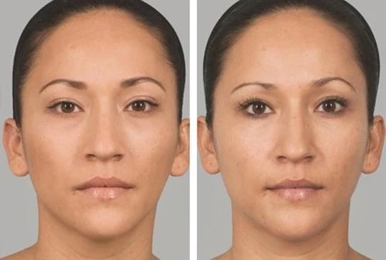 The Secret to Ageless Beauty: Sculptra Fillers in Saudi Arabia