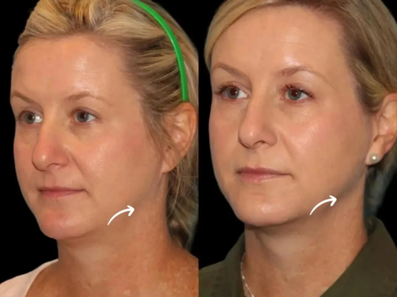 Sculptra Fillers Treatment in Dubai for Next Gen Skin Contouring