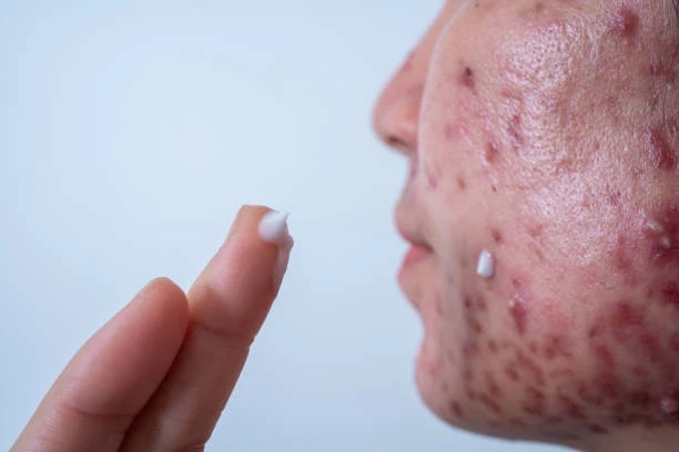 Best Rosacea Gels to Calm Your Skin
